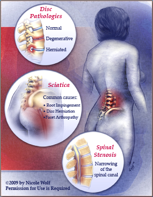 Lumbar Facet Pain